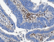 IHC staining of FFPE human rectal cancer with CD16 antibody. HIER: boil tissue sections in pH8 EDTA for 20 min and allow to cool before testing.