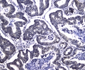 IHC staining of FFPE human intestinal cancer with DCK antibody at 1ug/ml. HIER: boil tissue sections in pH6, 10mM citrate buffer, for 10-20 min followed by cooling at RT for 20 min.