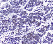 IHC staining of FFPE human lung cancer with DCK antibody at 1ug/ml. HIER: boil tissue sections in pH6, 10mM citrate buffer, for 10-20 min followed by cooling at RT for 20 min.