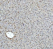 IHC staining of FFPE human lung cancer with DCK antibody at 1ug/ml. HIER: boil tissue sections in pH6, 10mM citrate buffer, for 10-20 min followed by cooling at RT for 20 min.