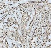 IHC staining of FFPE human breast cancer tissue with DCK antibody. HIER: boil tissue sections in pH8 EDTA for 20 min and allow to cool before testing.