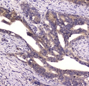 IHC staining of FFPE human intestinal cancer with CD2AP antibody at 1ug/ml. HIER: boil tissue sections in pH6, 10mM citrate buffer, for 10-20 min and allow to cool before testing.