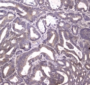 IHC testing of FFPE human rectal cancer tissue with HTRA1 antibody at 1ug/ml. Required HIER: steam section in pH6 citrate buffer for 20 min and allow to cool prior to staining.