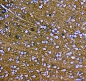 IHC testing of FFPE human glioma with SYT1 antibody at 1ug/ml. Required HIER: steam section in pH6 citrate buffer for 20 min and allow to cool prior to staining.