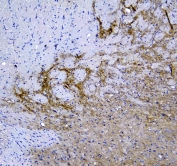 IHC testing of FFPE human melanoma with SYT1 antibody at 1ug/ml. Required HIER: steam section in pH6 citrate buffer for 20 min and allow to cool prior to staining.