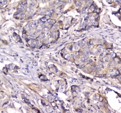 IHC testing of FFPE human breast cancer tissue with Dynamin 1 antibody at 1ug/ml. Required HIER: steam section in pH6 citrate buffer for 20 min and allow to cool prior to staining.