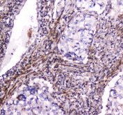 IHC testing of FFPE human lung cancer tissue with Dynamin 1 antibody at 1ug/ml. Required HIER: steam section in pH6 citrate buffer for 20 min and allow to cool prior to staining.