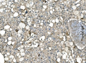 IHC staining of FFPE human liver cancer tissue with Serum Amyloid P antibody. HIER: boil tissue sections in pH8 EDTA for 20 min and allow to cool before testing.