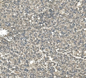IHC staining of FFPE human liver cancer tissue with Serum Amyloid P antibody. HIER: boil tissue sections in pH8 EDTA for 20 min and allow to cool before testing.