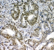 IHC testing of FFPE human colon cancer tissue with BLIMP1 antibody at 1ug/ml. Required HIER: steam section in pH6 citrate buffer for 20 min and allow to cool prior to staining.