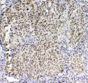 IHC testing of FFPE human lung cancer tissue with BLIMP1 antibody at 1ug/ml. Required HIER: steam section in pH6 citrate buffer for 20 min and allow to cool prior to staining.