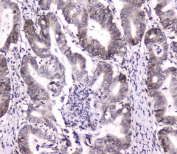 IHC testing of FFPE human rectal cancer tissue with DGCR8 antibody at 1ug/ml. Required HIER: steam section in pH6 citrate buffer for 20 min and allow to cool prior to staining.