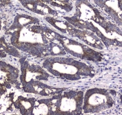 IHC testing of FFPE human colon cancer tissue with MRE11 antibody at 1ug/ml. Required HIER: steam section in pH6 citrate buffer for 20 min and allow to cool prior to staining.