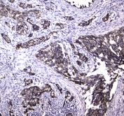 IHC testing of FFPE human breast cancer tissue with MRE11 antibody at 1ug/ml. Required HIER: steam section in pH6 citrate buffer for 20 min and allow to cool prior to staining.
