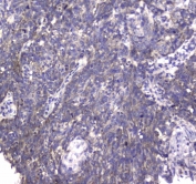 IHC testing of FFPE human lung cancer tissue with MRE11 antibody at 1ug/ml. Required HIER: steam section in pH6 citrate buffer for 20 min and allow to cool prior to staining.