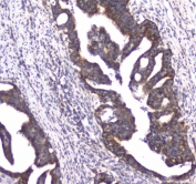 IHC testing of FFPE human rectal cancer tissue with CLPX antibody at 1ug/ml. Required HIER: steam section in pH6 citrate buffer for 20 min and allow to cool prior to staining.