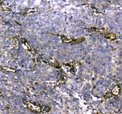 IHC testing of FFPE human lung cancer tissue with MYBPC3 antibody at 1ug/ml. Required HIER: steam section in pH6 citrate buffer for 20 min and allow to cool prior to staining.