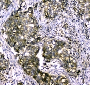 IHC testing of FFPE human breast cancer tissue with MYBPC3 antibody at 1ug/ml. Required HIER: steam section in pH6 citrate buffer for 20 min and allow to cool prior to staining.