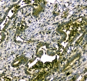 IHC testing of FFPE human rectal cancer tissue with MYBPC3 antibody at 1ug/ml. Required HIER: steam section in pH6 citrate buffer for 20 min and allow to cool prior to staining.