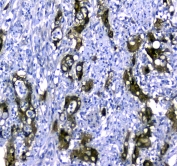 IHC testing of FFPE human colon cancer tissue with STUB1 antibody at 1ug/ml. Required HIER: steam section in pH6 citrate buffer for 20 min and allow to cool prior to staining.