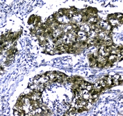 IHC testing of FFPE human lung cancer tissue with STUB1 antibody at 1ug/ml. Required HIER: steam section in pH6 citrate buffer for 20 min and allow to cool prior to staining.