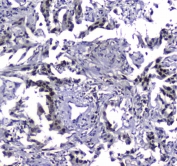 IHC testing of FFPE human lung cancer tissue with STUB1 antibody at 1ug/ml. Required HIER: steam section in pH6 citrate buffer for 20 min and allow to cool prior to staining.