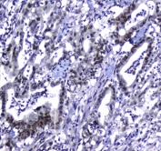 IHC testing of FFPE human colon cancer tissue with STUB1 antibody at 1ug/ml. Required HIER: steam section in pH6 citrate buffer for 20 min and allow to cool prior to staining.