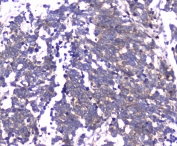 IHC testing of FFPE human lung cancer tissue with RAB27A antibody at 1ug/ml. Required HIER: steam section in pH6 citrate buffer for 20 min and allow to cool prior to staining.