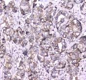 IHC testing of FFPE human breast cancer tissue with RAB27A antibody at 1ug/ml. Required HIER: steam section in pH6 citrate buffer for 20 min and allow to cool prior to staining.
