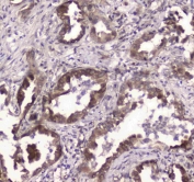 IHC testing of FFPE human lung cancer tissue with GLO1 antibody at 1ug/ml. Required HIER: steam section in pH6 citrate buffer for 20 min and allow to cool prior to staining.