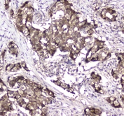 IHC testing of FFPE human breast cancer tissue with GLO1 antibody at 1ug/ml. Required HIER: steam section in pH6 citrate buffer for 20 min and allow to cool prior to staining.