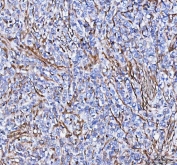 IHC testing of FFPE human breast cancer tissue with S100A10 antibody at 1ug/ml. Required HIER: steam section in pH6 citrate buffer for 20 min and allow to cool prior to staining.