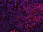 Immunofluorescent staining of FFPE human lung cancer tissue with S100A10 antibody (red) and DAPI nuclear stain (blue). HIER: steam section in pH8 EDTA buffer for 20 min.