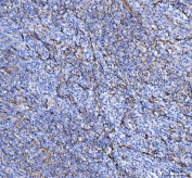 IHC testing of FFPE human rectal cancer tissue with S100A10 antibody at 1ug/ml. Required HIER: steam section in pH6 citrate buffer for 20 min and allow to cool prior to staining.