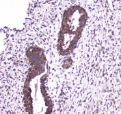 IHC testing of FFPE human colon cancer tissue with Caspase 4 antibody at 1ug/ml. Required HIER: steam section in pH6 citrate buffer for 20 min and allow to cool prior to staining.