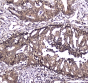 IHC testing of FFPE human breast cancer tissue with Caspase 4 antibody at 1ug/ml. Required HIER: steam section in pH6 citrate buffer for 20 min and allow to cool prior to staining.