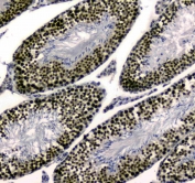 IHC testing of FFPE human colon cancer tissue with UBA2 antibody at 1ug/ml. Required HIER: steam section in pH6 citrate buffer for 20 min and allow to cool prior to staining.