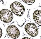 IHC testing of FFPE human breast cancer tissue with UBA2 antibody at 1ug/ml. Required HIER: steam section in pH6 citrate buffer for 20 min and allow to cool prior to staining.