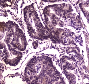IHC testing of FFPE human intestinal cancer tissue with BRG1 antibody at 1ug/ml. Required HIER: steam section in pH6 citrate buffer for 20 min and allow to cool prior to staining.