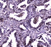 IHC testing of FFPE human lung cancer tissue with TLR1 antibody at 1ug/ml. Required HIER: steam section in pH6 citrate buffer for 20 min and allow to cool prior to staining.