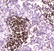 IHC testing of FFPE human lung cancer tissue with Lactoferrin antibody at 1ug/ml. Required HIER: steam section in pH6 citrate buffer for 20 min and allow to cool prior to staining.
