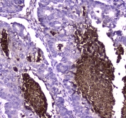 IHC testing of FFPE human intestinal cancer tissue with Lactoferrin antibody at 1ug/ml. Required HIER: steam section in pH6 citrate buffer for 20 min and allow to cool prior to staining.