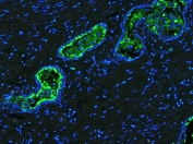 Immunofluorescent staining of human prostate cancer tissue with Lactoferrin antibody (green) and DAPI nuclear stain (blue). HIER: steam section in pH6 citrate buffer for 20 min.