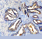 IHC staining of FFPE human prostate cancer tissue with Lactoferrin antibody, HRP-secondary and DAB substrate. HIER: boil tissue sections in pH8 EDTA for 20 min and allow to cool before testing.