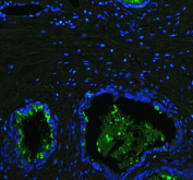Immunofluorescent staining of human prostate cancer tissue with Lactoferrin antibody (green) and DAPI nuclear stain (blue). HIER: steam section in pH6 citrate buffer for 20 min.
