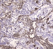 IHC testing of FFPE human lung cancer tissue with MVP antibody at 1ug/ml. Required HIER: steam section in pH6 citrate buffer for 20 min and allow to cool prior to staining.