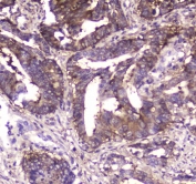 IHC testing of FFPE human intestinal cancer tissue with MVP antibody at 1ug/ml. Required HIER: steam section in pH6 citrate buffer for 20 min and allow to cool prior to staining.