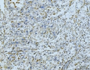 IHC staining of FFPE human liver cancer tissue with CD163 antibody at 1ug/ml. Required HIER: steam section in pH8 EDTA for 20 min and allow to cool prior to staining.