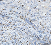 IHC staining of FFPE human gall bladder adenosquamous carcinoma tissue with CD163 antibody at 1ug/ml. Required HIER: steam section in pH8 EDTA for 20 min and allow to cool prior to staining.