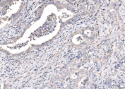 IHC staining of FFPE human appendiceal adenocarcinoma tissue with CD163 antibody at 1ug/ml. Required HIER: steam section in pH8 EDTA for 20 min and allow to cool prior to staining.